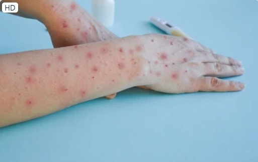 Virus-Marburg-2