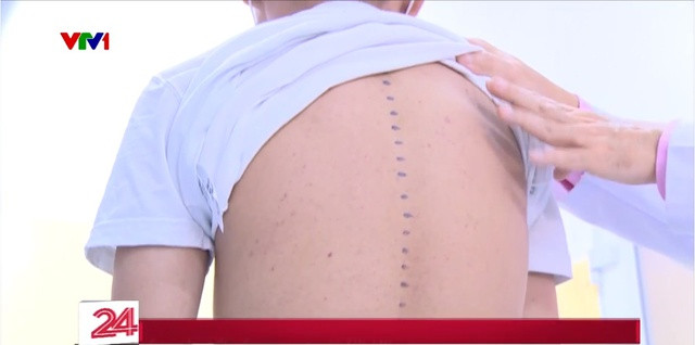 Cảnh báo cong vẹo cột sống ở học sinh