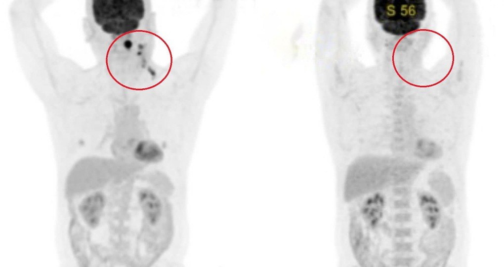 Kết quả chụp PET CT của ông Chiến sau 2 năm điều trị cho thấy hạch tan hoàn toàn. Ảnh: Bệnh viện Đa khoa Tâm Anh