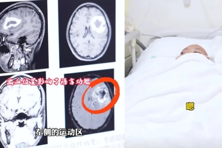 Bệnh nhân bị xuất huyết trong não, ảnh hưởng đến khả năng ngôn ngữ. Ảnh: Oddity Central