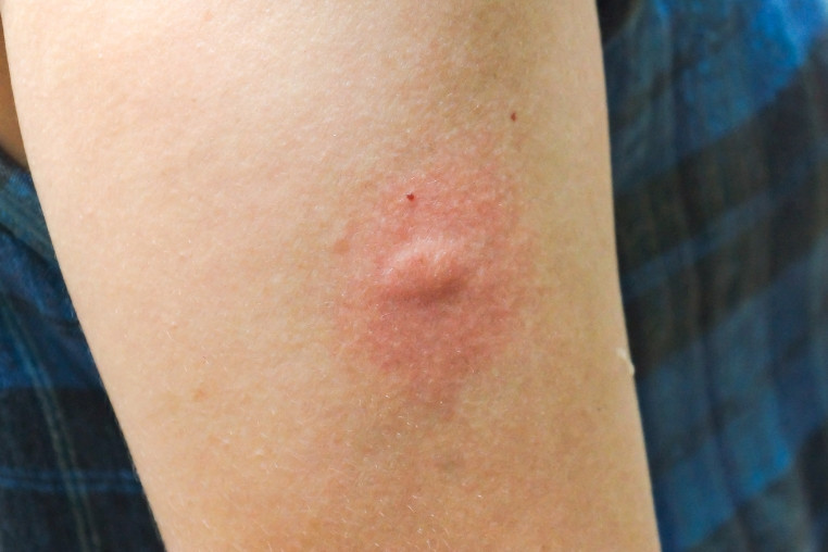 Vì sao muỗi chỉ đốt một mình bạn? 