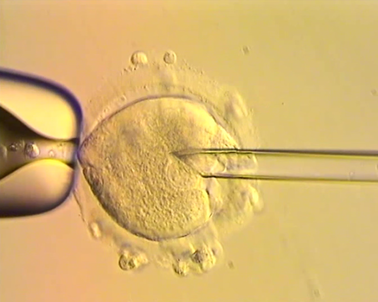 IVF