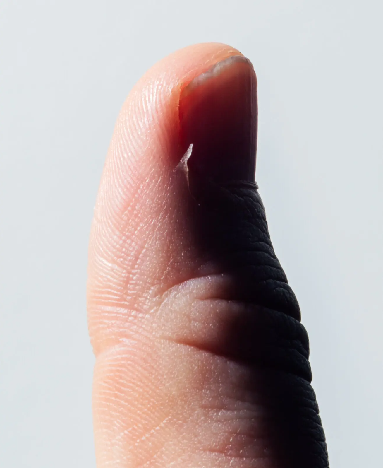 hangnail