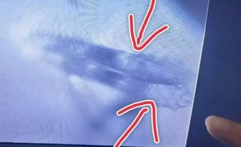 Khám mắt cho người phụ nữ, bác sĩ sốc nặng khi phát hiện điều đáng sợ - Ảnh 2.