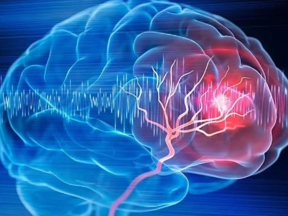 Người phụ nữ 57 tuổi bất ngờ phát hiện khối u não nhờ đồng hồ đeo tay - Ảnh 1.