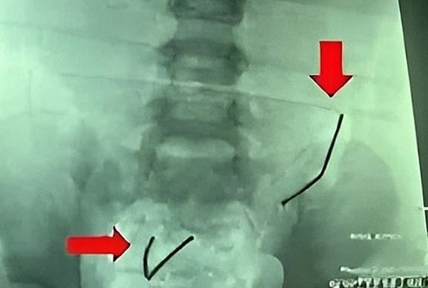 Bé trai 5 tuổi đau bụng, nôn ói, gia đình đưa đi kiểm tra thì sốc nặng - Ảnh 1.