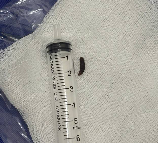 Thấy trẻ bị đau tai kèm chảy máu, gia đình đưa đi khám thì sốc nặng - Ảnh 1.