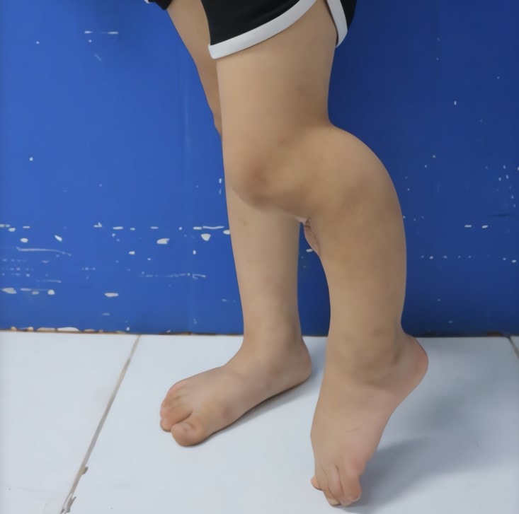 chan-be-gai-bi-gay-xuong-vi-dap-la.jpg