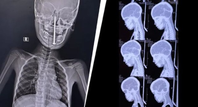 Phẫu thuật cho bé trai 7 tuổi, bác sĩ sốc nặng khi lấy ra "thứ đáng sợ" - Ảnh 1.