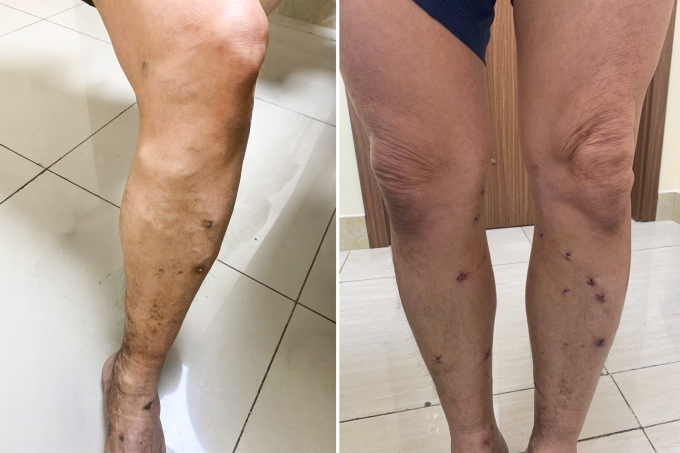 Chân ông Tám nổi nhiều mạch máu nhỏ, sạm da (bên trái) và sau khi điều trị suy giãn tĩnh mạch (bên phải). Ảnh: Phòng khám Đa khoa Tâm Anh Quận 7