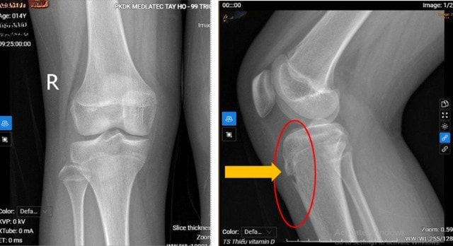 "Thủ phạm" khiến bé gái 14 tuổi bỗng dưng đau khớp gối - Ảnh 1.