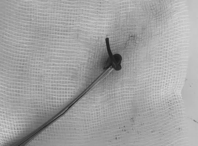 Cô gái 21 tuổi đau nhói ở mũi, bác sĩ sốc nặng khi phát hiện "thứ đáng sợ" bên trong - Ảnh 1.