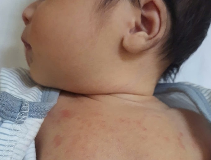 Mụn sữa ở trẻ sơ sinh xuất hiện chủ yếu trên mặt, lưng hoặc ngực trong vài tuần đầu đời. Ảnh minh họa: Thanh Ba