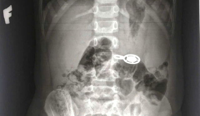 Nuốt móc khóa khi ngủ trưa, bé 4 tuổi phải nhập viện cấp cứu- Ảnh 1. Nuốt móc khóa khi ngủ trưa, bé 4 tuổi phải nhập viện cấp cứu- Ảnh 1.