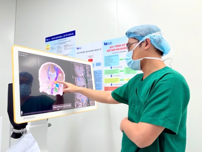 Bác sĩ dựng hình 3D trước mổ để xác định chính xác vị trí ổ động kinh của anh Khang. Ảnh: Bệnh viện Đa khoa Tâm Anh