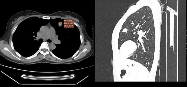 Dấu hiệu âm thầm tưởng vô hại nhưng có thể là ung thư phổi- Ảnh 1.