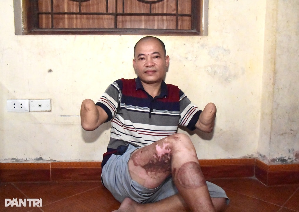 Bố tai nạn cụt 2 tay, mẹ thường đau yếu, 6 con lâm cảnh bế tắc - 1 Bố tai nạn cụt 2 tay, mẹ thường đau yếu, 6 con lâm cảnh bế tắc - 1