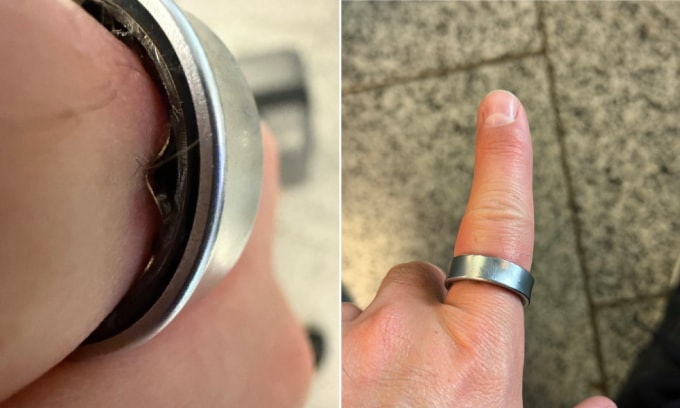 Nhẫn Galaxy Ring biến dạng và mắc kẹt trên ngón tay Daniel Rotar. Ảnh: X/Daniel Rotar