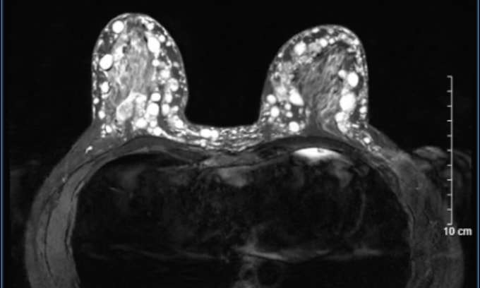 Hình ảnh các hạt sillicone vú trên phim MRI. Ảnh: Bác sĩ cung cấp
