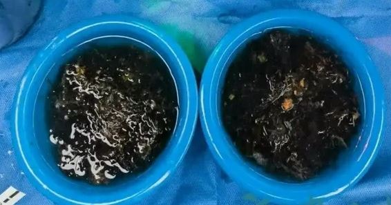 Con gái 10 tuổi kêu đau bụng suốt 3 năm, cha mẹ đưa đi kiểm tra thì sốc nặng- Ảnh 2.