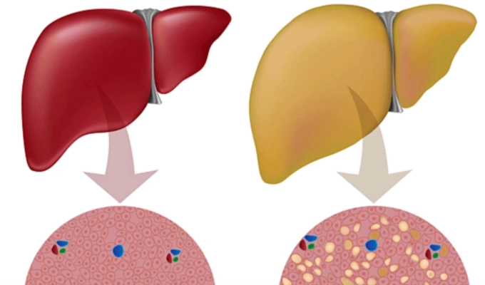 Mô phỏng gan khỏe mạnh (trái) và gan nhiễm mỡ (phải). Ảnh: Healthline