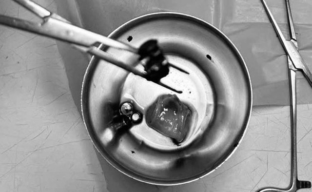 Bé trai 4 tuổi đau bụng dữ dội, nôn ói, bác sĩ gắp ra thứ "đáng sợ" bên trong- Ảnh 1. Bé trai 4 tuổi đau bụng dữ dội, nôn ói, bác sĩ gắp ra thứ "đáng sợ" bên trong- Ảnh 1.