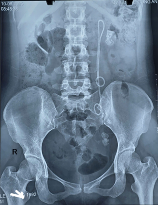 Người phụ nữ 33 tuổi đau tức thắt lưng, tiểu buốt, bác sĩ gắp ra thứ "đáng sợ" bên trong- Ảnh 1.