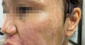 Kem trị nám được ưa chuộng bị phát hiện sai công thức, buộc tiêu huỷ toàn bộ- Ảnh 6.