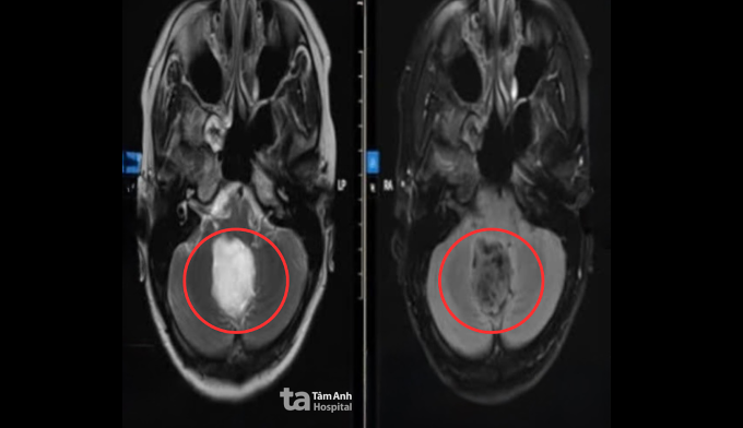 Ảnh chụp MRI u thân não của chị Trang. Ảnh: Bệnh viện Đa khoa Tâm Anh