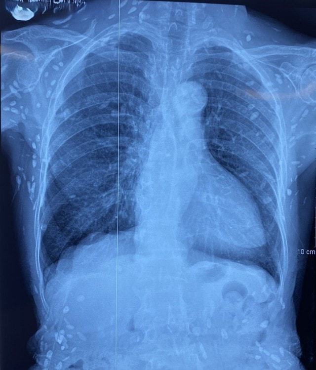 Chụp X-quang ngực cho người phụ nữ 77 tuổi, bác sĩ sốc nặng khi phát hiện "bí mật đáng sợ" - Ảnh 2.