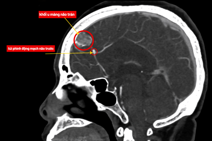 Ảnh chụp MRI khối u và túi phình mạch não của bà Hiền. Ảnh: Bệnh viện Đa khoa Tâm Anh