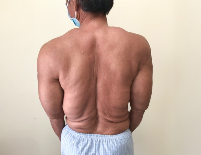 Các u tế bào mỡ làm cơ thể người bệnh sưng to bất thường. Ảnh: Phòng khám Đa khoa Tâm Anh Quận 7