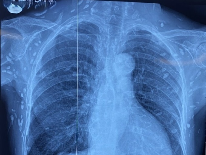 Phim chụp cho thấy nhiều nang sán tại thành ngực-bụng và chi trên bệnh nhân. Ảnh: Bệnh viện cung cấp