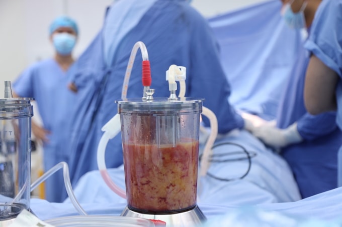 Hút mỡ tại Bệnh viện Da Liễu TP HCM. Ảnh: Bệnh viện cung cấp