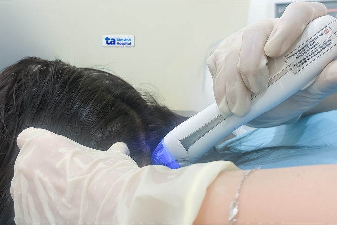 Chị Lan được điều trị tình trạng rụng tóc bằng vi kim RF. Ảnh: Bệnh viện Đa khoa Tâm Anh