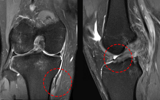Phim MRI cho thấy các vị trí đứt dây chằng của Hiệp. Ảnh: Bệnh viện Đa khoa Tâm Anh
