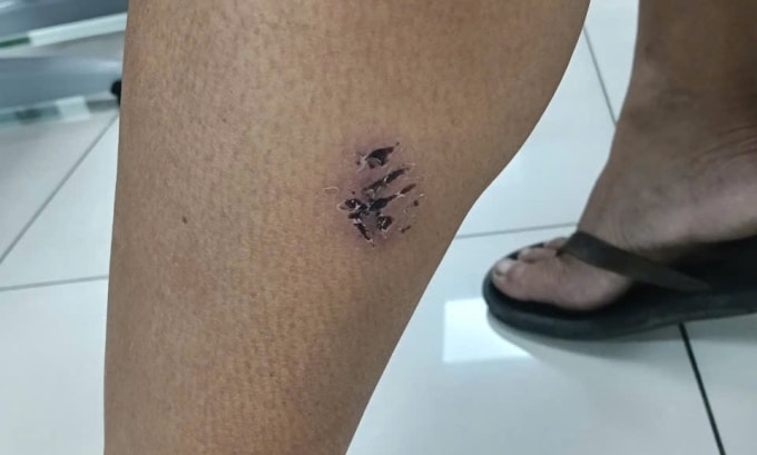 Vết thương bị chó cắn ở chân của anh Tú. Ảnh: Khánh Hòa