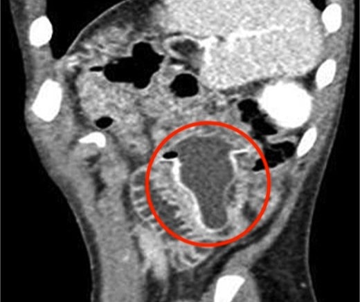 Bé trai 10 tuổi nôn mửa, đau bụng suốt 4 ngày, bác sĩ sốc nặng khi phát hiện "bí mật" đáng sợ - Ảnh 1.