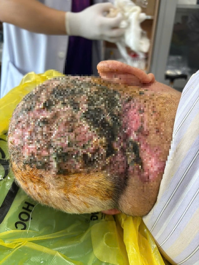 Tin lời “chữa mẹo”, cụ ông 88 tuổi rơi vào cơn nguy kịch- Ảnh 1. Tin lời “chữa mẹo”, cụ ông 88 tuổi rơi vào cơn nguy kịch- Ảnh 1.