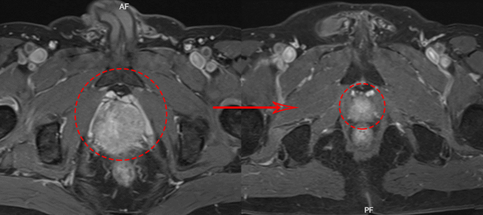 Chụp MRI tuyến tiền liệt của bệnh nhân trước (bên trái) và sau điều trị (bên phải). Ảnh: Bệnh viện Đa khoa Tâm Anh