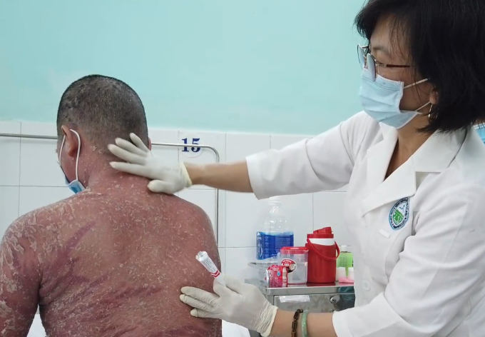 Bệnh nhân vảy nến điều trị tại Bệnh viện Da Liễu TP HCM. Ảnh: Bệnh viện cung cấp