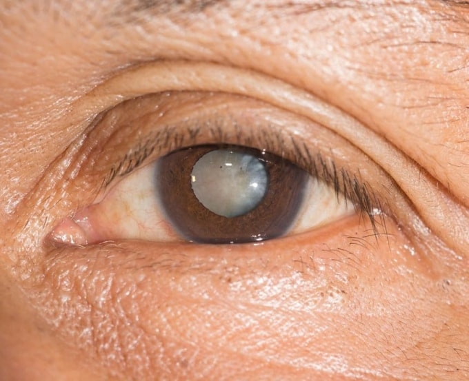 Có hơn 600.000 người mắc các bệnh lý về mắt bị mất thị lực hoàn toàn. Ảnh: Hikari Eye Care