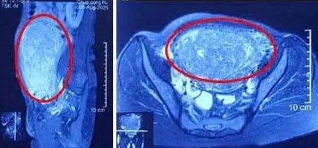 Người phụ nữ 47 tuổi bụng to như mang song thai, bác sĩ lấy ra "thứ đáng sợ" - Ảnh 2.