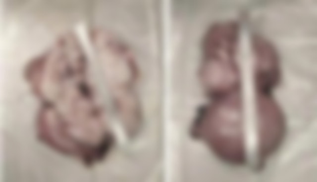 Người phụ nữ 47 tuổi bụng to như mang song thai, bác sĩ lấy ra "thứ đáng sợ" - Ảnh 1.