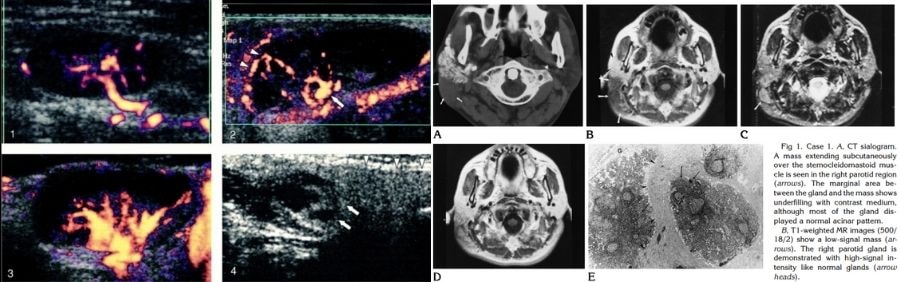 Bên trái là ảnh siêu âm và bên phải là ảnh chụp CT của bệnh Kimura (Pathologyoutlines) (