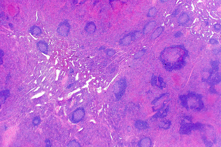 Bệnh Kimura: Kẻ mạo danh bệnh K