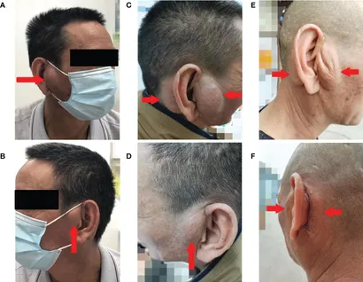 Bệnh Kimura được phát hiện phổ biến ở nam giới gốc Á (Frontiersin)