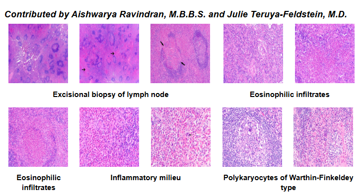 Hình ảnh vi mô của bệnh Kimura (Pathologyoutlines)