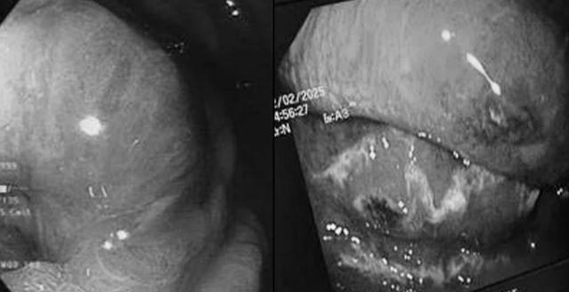 "Thủ phạm" khiến người đàn ông 68 tuổi nguy kịch, dạ dày và thực quản hoại tử nặng - Ảnh 1.