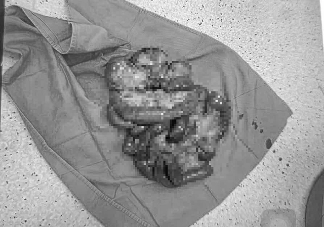 Người đàn ông 60 tuổi đau bụng dữ dội, bác sĩ gắp ra thứ "đáng sợ" bên trong - Ảnh 1.